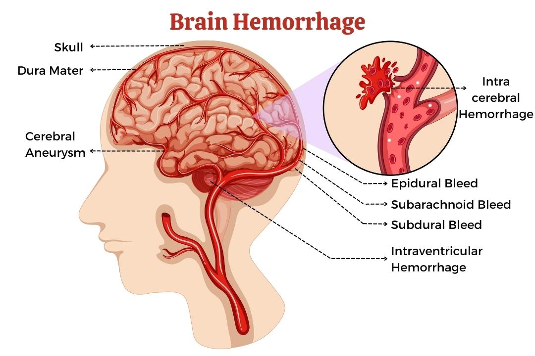 3-modern-treatment-techniques-for-brain-bleeds-old-ways-to-new-ways