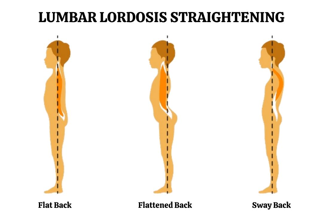 Lumbar Lordosis Straightening Know The Risks And How To Overcome