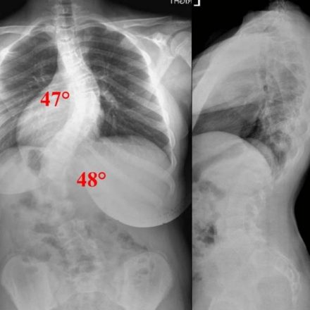 Levoscoliosis